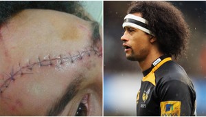 VIDEO. Aj Quasimodo by mu závidel... Hororová jazva rugbistu!