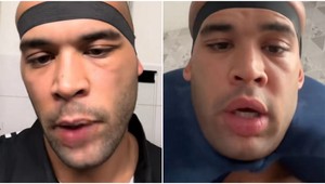 Po transplantácii vlasov zažil šok! Mužovi narástla hlava ako melón!