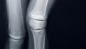 Z röntgenu kolena možno zistiť, či niekto pije pivo