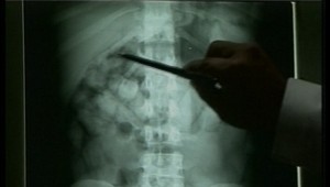 Politik pašoval drogy v žalúdku