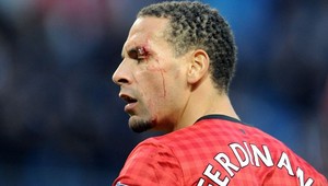 Po oslave gólu United R. Ferdinand (34) s krvou na tvári
