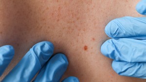 Našli ste si malé červené bodky na tele? TOTO by ste mali vedieť!