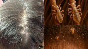 VŠI u detí? Žiadna dráma! TAKTO ich doma ZLIKVIDUJETE rýchlo a BEZ STRESU!