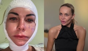 ŠOK po facelifte Moniky Nemčokovej: Ochabla jej časť tváre! TAKTO vyzerá dnes