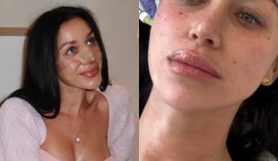 Bianka Rumanová opäť mení tvár: Fanúšikom ukázala zákrok, ktorý nie je pre SLABÉ povahy!