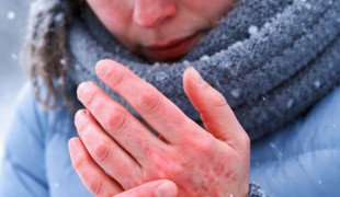 Trpíte v MRAZOCH viac než iní? 6 príznakov, že máte alergiu na chlad!