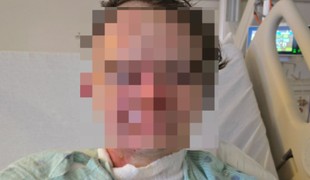 Mladík utrpel vážne popáleniny po útoku kolegu. Vylial naňho žeravý olej