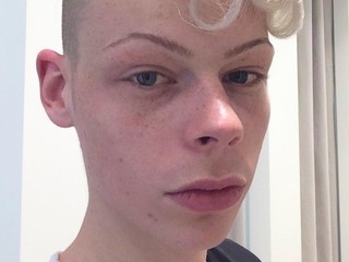 Takto už nevyzerá! Patrick si plastikami plní sen, odpadnete, čo so sebou urobil!