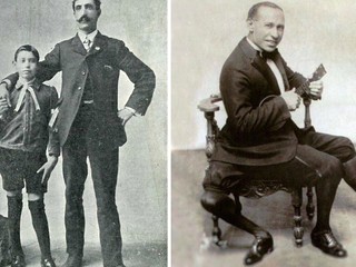 Narodil sa s tromi nohami a dvomi penismi: Napriek tomu prežil úspešný život