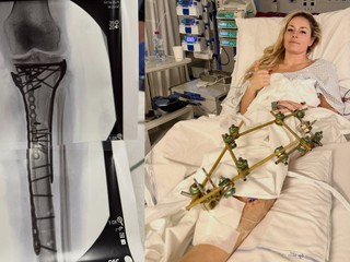 Hrozila mi amputácia, potvrdila Lindsey VONN