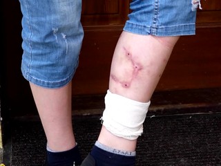 Pes pohrýzol dieťa až do krvi. Polícia najprv obvinila maloletého