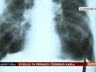 Keď rastie nádor pľúc, objavuje sa okrem kašľa aj iných 9 nečakaných príznakov. Onkologička ich popísala