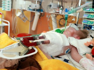 Dieťa čakalo na transplantáciu, pri živote ho držalo mechanické srdce