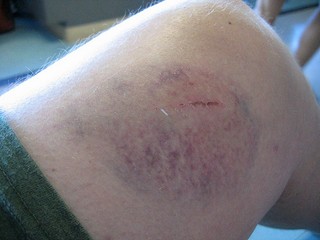 Prečo sa vám ľahko tvoria modriny? Problémom môže byť opaľovanie, málo vitamínov, či dedičnosť