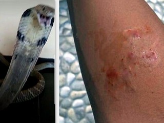 Chlapca pohrýzla kobra. S výzvou o pomoc pridal fotku na sociálnu sieť