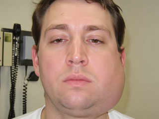 Postrach chlapcov a mladých mužov: Čo je to mumps a ako sa pred ním chrániť?