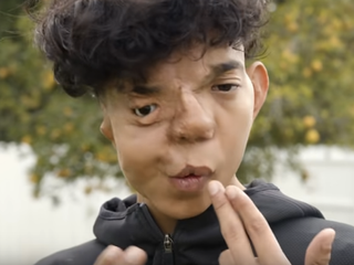 Neuveriteľné: Na operácie už minul milión dolárov, no nehanbí sa za svoju zdeformovanú tvár