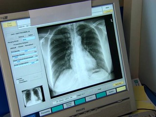 13 ochorení, ktoré ohrozujú vaše pľúca: Čo robiť, ak sa vám ťažko dýcha?