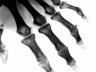 Choroba kráľov:  ZÁCHVAT DNY vás môže zastihnúť z ničoho nič