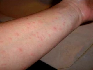 V Bratislavskom kraji pribudol šiesty nakazený osýpkami