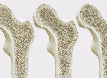 Pacienti s kostnými metastázami sa môžu liečiť cielene.  Liečba u nich odďaľuje nástup bolesti i vážne komplikácie