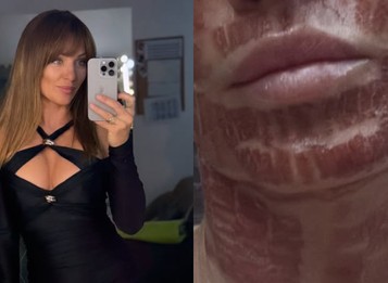 Alexandra Orviská šokovala vzhľadom po zákroku: TVÁR ako z hororu! TOTO fakt dala?!