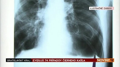 Keď rastie nádor pľúc, objavuje sa okrem kašľa aj iných 9 nečakaných príznakov. Onkologička ich popísala