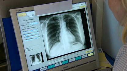 7 príznakov pľúcnej embólie: Čo vás môže varovať?