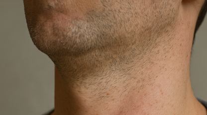 Nie je to len problém žien! Mužom kvôli HPV hrozí rakovina penisu aj krku, varujú odborníci