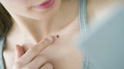 Dermatológ: Nechajte si pred letom skontrolovať znamienka, má to význam