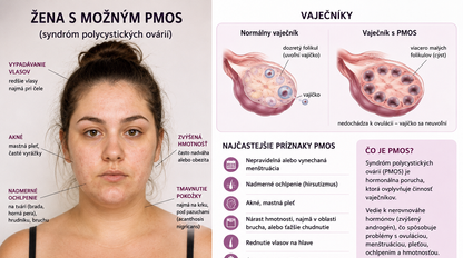 Štúdia zistila, že ženy s hormonálnymi problémami čelia štvornásobne vyššiemu riziku srdcových ochorení