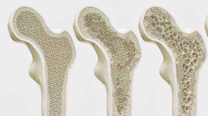 Osteoporóza je detská choroba,ktorá sa prejaví v dospelosti: Ako sa lieči?