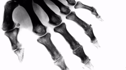 Choroba kráľov:  Záchvat dny vás môže zastihnúť z ničoho nič