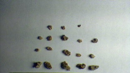 Najhoršia bolesť: 7 spôsobov, ako sa vyhnúť obličkovým kameňom