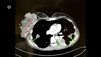 Mamografia je dostupnejšia, záujem žien o preventívne vyšetrenie je stále nízky