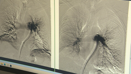 Sekundy rozhodujú. Lekári zachraňujú pacientov s pľúcnou embóliou unikátnym zákrokom