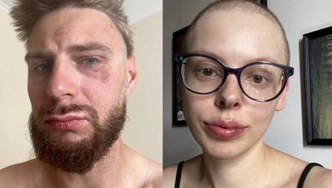 Jakuba zbili pre žltomodré farby na čiapke. Chcel vyzbierať peniaze pre partnerku s rakovinou