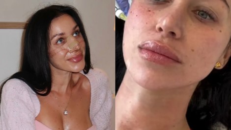 Bianka Rumanová opäť mení tvár: Fanúšikom ukázala zákrok, ktorý nie je pre SLABÉ povahy!
