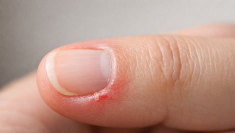 Zádery na prstoch nie sú len kozmetický problém: Prečo vznikajú a ako sa ich zbaviť?