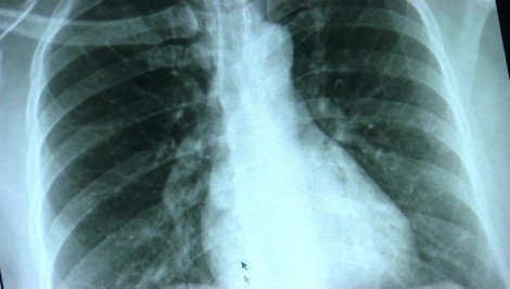 NENÁPADNÝ ZABIJAK:  Rakovinu pľúc ľudia často považujú za pretrvávajúcu infekciu