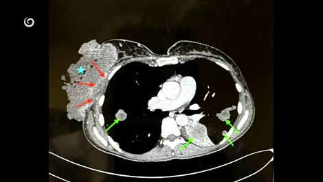 Mamografia je dostupnejšia, záujem žien o preventívne vyšetrenie je stále nízky