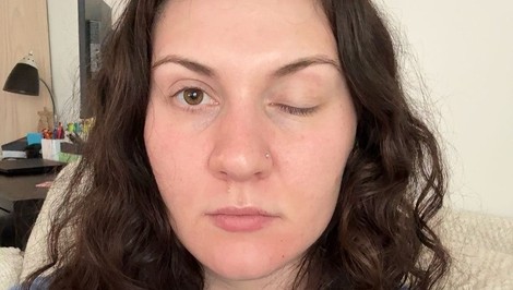 Po aplikácii BOTOXU jej ochrnulo viečko: Lydia ani 2 mesiac PO oko neotvorí