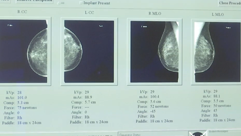 Vedci našli možný kľúč, ako zablokovať rakovinu prsníka ešte pred nádorom