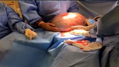 Kde všade V TELE môžete mať CYSTU? Nemusíte o nich ani vedieť