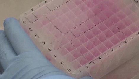 Na Slovensku potvrdili prípad opičích kiahní. Pacienta hospitalizovali na infekčnom oddelení