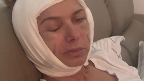 Opuchy, podliatiny, nefungujúce svaly! Česká herečka ukázala desivú tvár a priznala, čo je za tým!