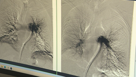 Sekundy rozhodujú. Lekári zachraňujú pacientov s pľúcnou embóliou unikátnym zákrokom