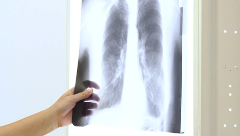 Pľúcna embolía: Zákerný stav, ktorý je náročné zistiť