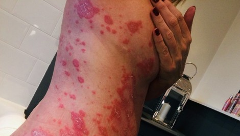 Sprievodca 13 autoimunitnými ochoreniami: Keď sa telo "zblázni" a zaútočí samé na seba