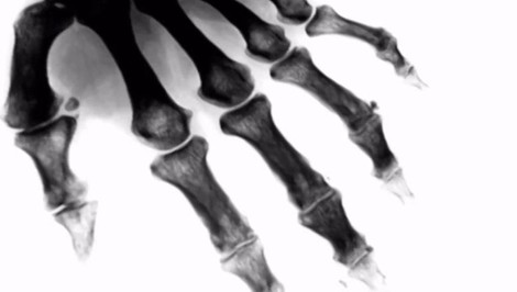 Choroba kráľov:  ZÁCHVAT DNY vás môže zastihnúť z ničoho nič